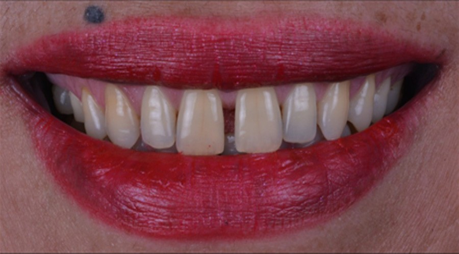 بعد تجميل وزراعةالاسنان فينير 2